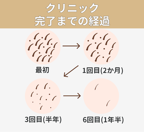 女性のひげ脱毛にはクリニックがおすすめ 自己処理の方法や回数 値段も徹底解説 部位 脱毛 おすすめの脱毛クリニック 脱毛サロン紹介メディア
