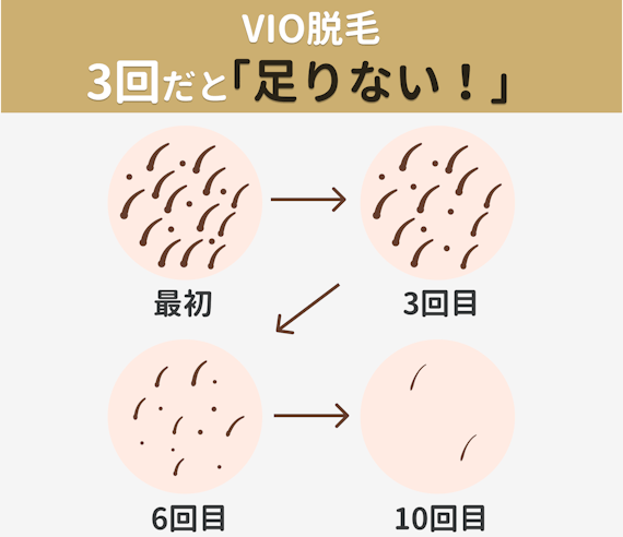 Vio脱毛の形を人気順に紹介 男ウケがいいのはどれ 自己処理の仕方も解説 部位 脱毛 おすすめの脱毛クリニック 脱毛サロン紹介メディア